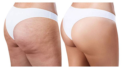 How to get rid of cellulite: 15 expert tips from dermatologists